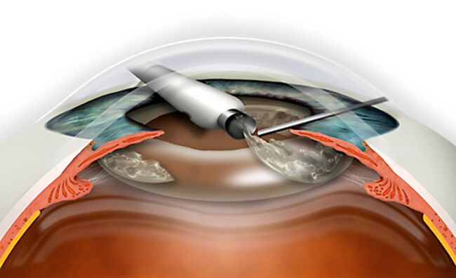 The refraction replacement of the lens is carried out through micronadle, which excludes blood loss