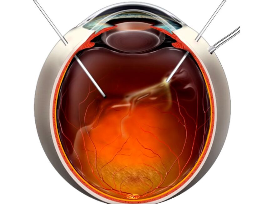 Vitrectomy A procedure that shows people when retinal exfoliation